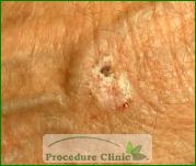 squamous